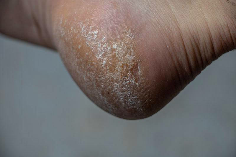 How to get rid of deep calluses on foot