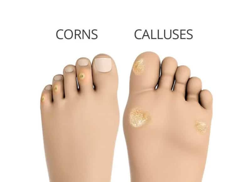 What is Corns and Calluses: Types, Symptoms, and Causes