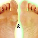 How to avoid and prevent corns and calluses on feet lifestyle major