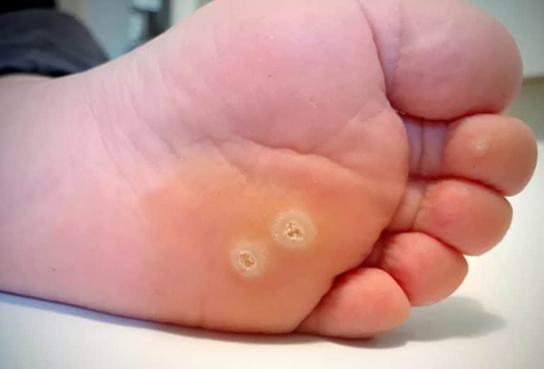 How to get rid of a deep callus on the bottom of your foot?