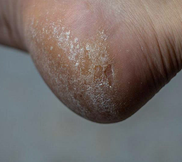 How To Permanently Get Rid of Calluses on Feet?