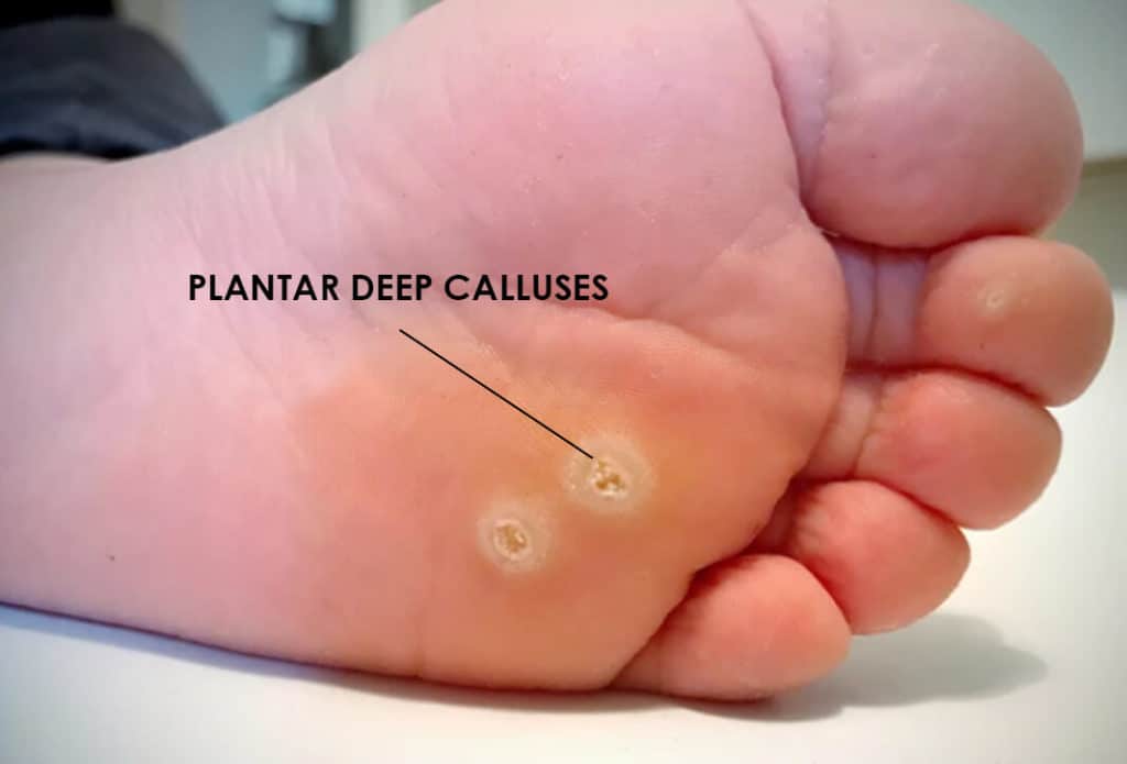 Plantar deep calluses bottom of your foot