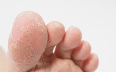 get rid of calluses on foot